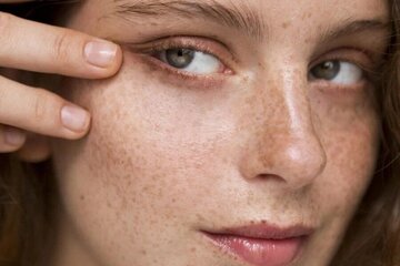 آشنایی با انواع لک‌های پوستی