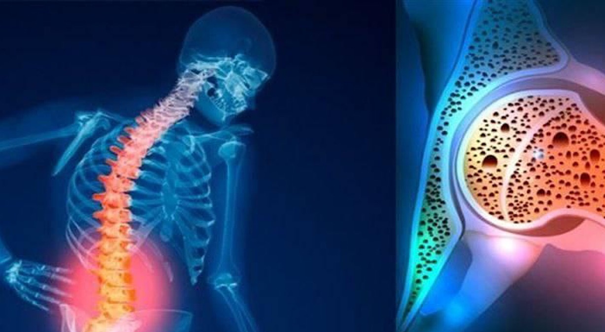 شکستگی، تنها نشانه پوکی استخوان است