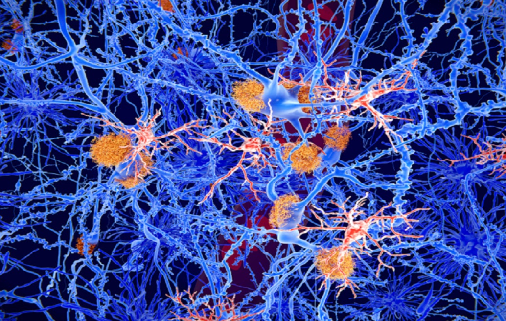درمانی نوآورانه برای صرع که حافظه را بازیابی و از تشنج جلوگیری می‌کند