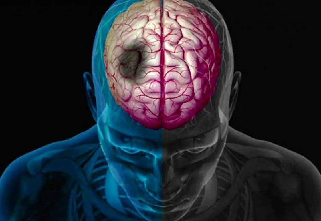 چگونه زمستان خطر سکته مغزی را افزایش می‌دهد؟