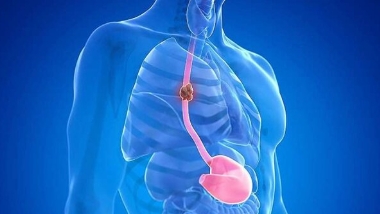 نکاتی درباره سرطان مری